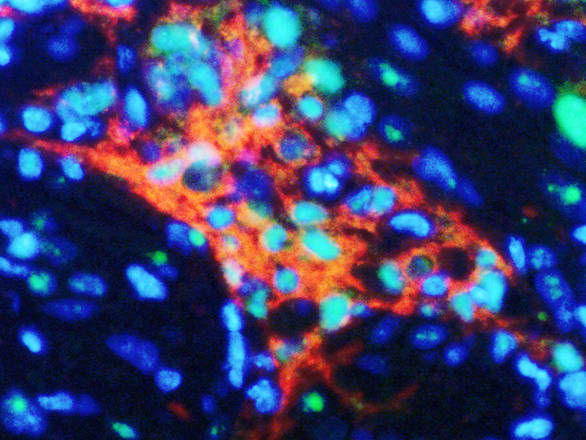 Cellule staminali: scoperto il gruppo di cellule causa dei tumori al cervello
