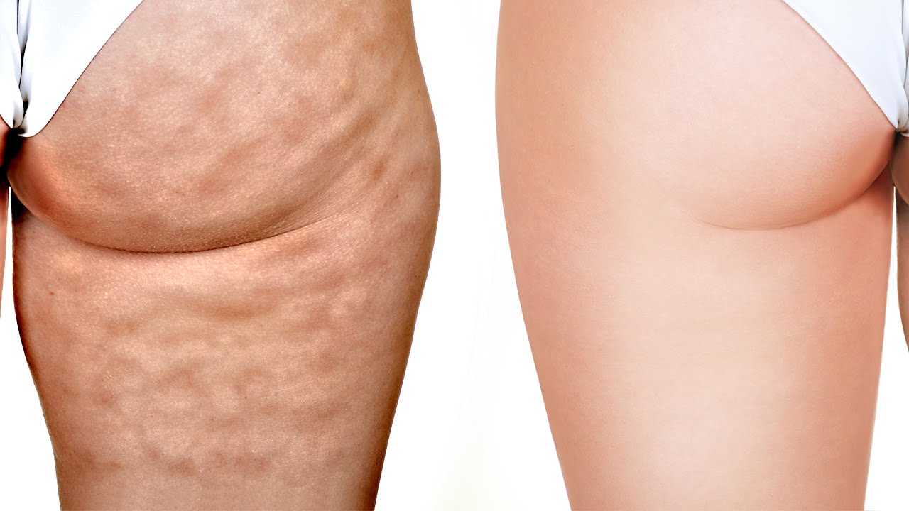 Crema anticellulite Adonia Legtone